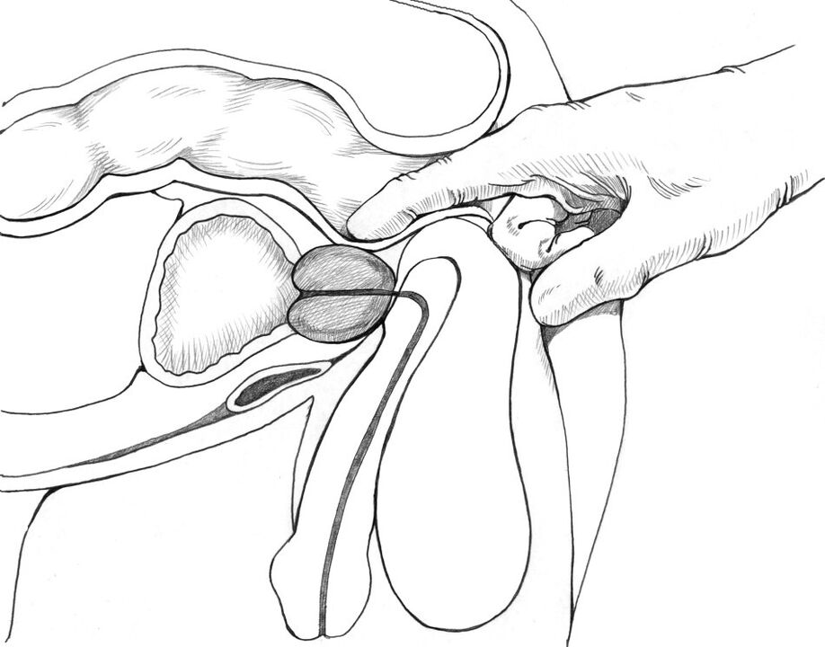 Prostate massage is included in the complex of methods for treating prostatitis